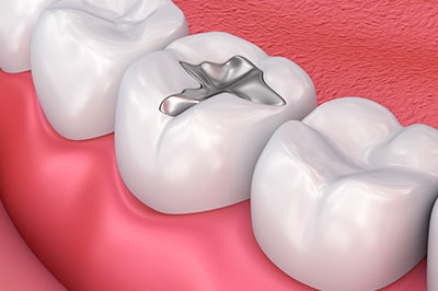 Glendale Family Dental | Ceramic Crowns, Teeth Whitening and Implant Restorations