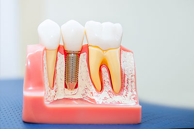 Glendale Family Dental | Veneers, Ceramic Crowns and Invisalign reg 