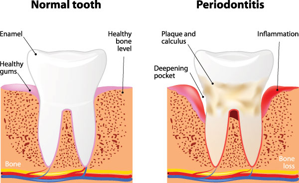 Glendale Family Dental | Periodontal Treatment, Dental Cleanings and Invisalign reg 