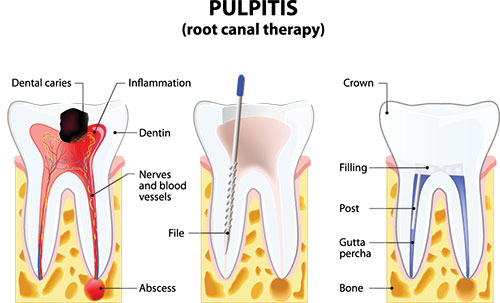 Glendale Family Dental | Night Guards, Oral Exams and Implant Restorations