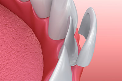 Glendale Family Dental | Dentures, Implant Dentistry and Digital Impressions